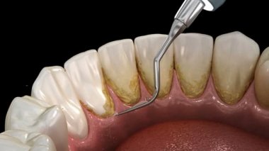 Ağız hijyeni: Ultrasonik diş temizleme makinesi kalkülüs ve plak kaldırma. İnsan diş tedavisi tıbbi olarak doğru 3d illüstrasyon