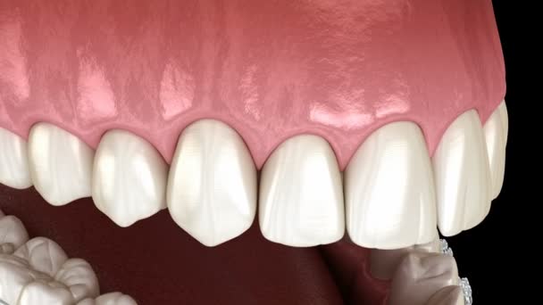 Braces claires installer d'autres dents. Animation 3D — Video