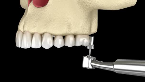 Sinus-Lift-Chirurgie - Sinus-Augmentation. 3D-Animation. — Stockvideo