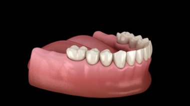 Mandibular protez Tüm 4 sistem implantlar tarafından desteklenir. İnsan dişleri ve protezkavramının tıbbi olarak doğru 3d animasyonu
