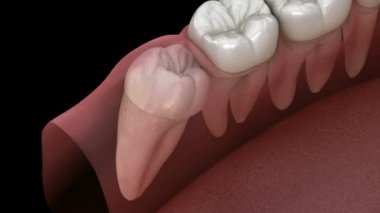 Mesial impaction ile sağlıklı dişler ve bilgelik diş . Tıbbi olarak doğru diş 3d animasyon