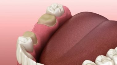 Azı dişleri ve premolar üzerinde 3 diş Diş köprüsü. İnsan diş tedavisi tıbbi olarak doğru 3d animasyon