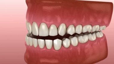 Underbite diş tıkanıklığı ( Dişlerin maloklüzyon ). Tıbbi olarak doğru diş 3d animasyon