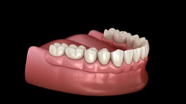Alt çene çıkarılabilir protez. Hepsi top eklentili implantlar tarafından desteklenen 2 sistemde. Tıbben doğru 3 boyutlu diş canlandırması.
