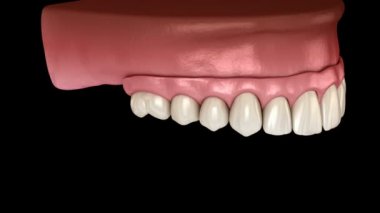 Maxillary protezi. Hepsi implantlar tarafından desteklenen 4 sistemde. İnsan dişleri ve protez kavramının tıbbi olarak doğru üç boyutlu animasyonu