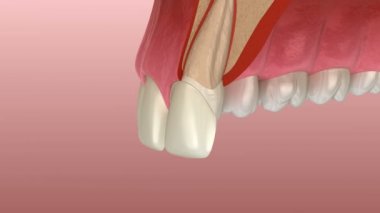 Merkezi kesici diş ve lateral kesici üzerine kaplama montaj prosedürü. Dilimlenmiş görünüm. Tıbbi olarak doğru diş 3d animasyon