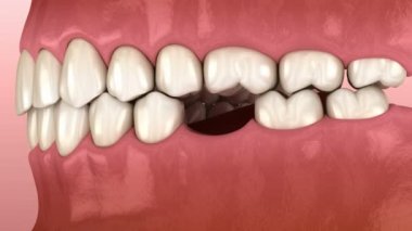 Dişler azı dişi kaybettikten sonra deformatiuon kaydırın. Popov Godon fenomeninin 3d animasyonu