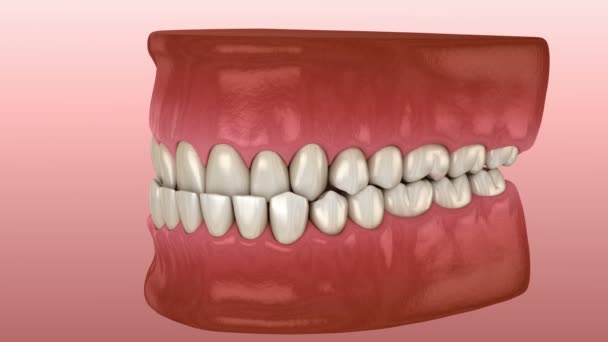 Подкусывание зубов (малокклюзия зубов). Медицинская точность 3D анимации зубов — стоковое видео