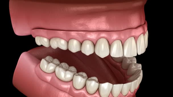 Maxillary Protezi Hepsi Implantlar Tarafından Desteklenen Sistemde Nsan Dişleri Protez — Stok video