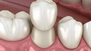 Diş taç yerleştirme için önceden paralanmış premolar diş. Tıbbi olarak doğru 3d animasyon