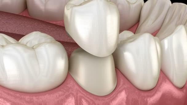 Preparált premoláris fog a fogászati korona elhelyezése. Orvosilag pontos 3D animáció — Stock videók