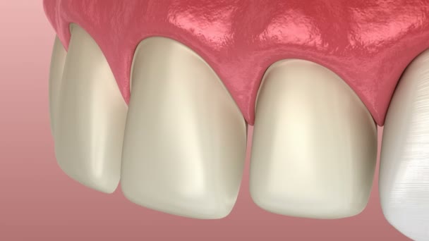 Procedimento de instalação do folheado sobre incisivo central e incisivo lateral. Animação 3D de dente medicamente precisa — Vídeo de Stock