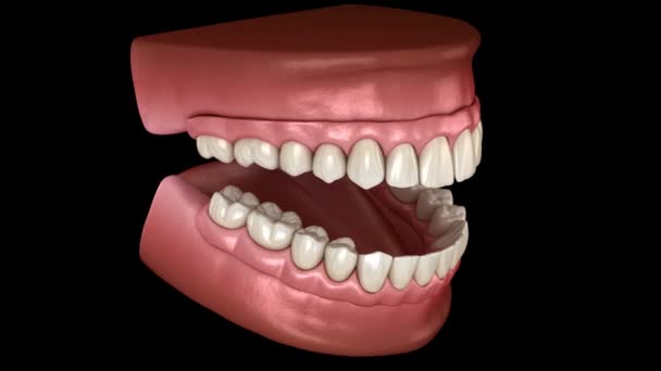 上顎プロテーゼインプラントでサポートされている4つのシステム上のすべて。人間の歯と入れ歯の概念の医学的に正確な3Dアニメーション — ストック動画