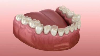 Diş yıpratma (Bruksizm) diş dokusu kaybına neden olur. Tıbbi olarak doğru diş 3d animasyon