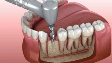 Ayrıntılı olarak implantasyon süreci: Sondaj 3d animasyon, implantat instalation, abutment ve taç fiksasyon