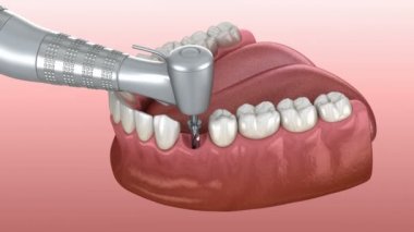 Ayrıntılı olarak implantasyon süreci: Sondaj 3d animasyon, implantat instalation, abutment ve taç fiksasyon