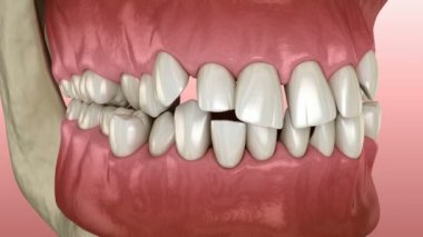 Anormal diş pozisyonu, ortodontik konsept. Tıbbi olarak doğru diş 3D animasyonu