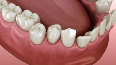 Anormal diş pozisyonu, ortodontik konsept. Tıbbi olarak doğru diş 3D animasyonu