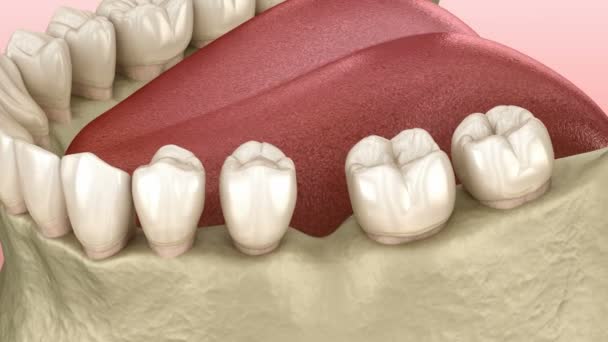 Tänder Skift deformatiuon efter att ha förlorat molar tand. 3D-animering av Popov Godon fenomen — Stockvideo