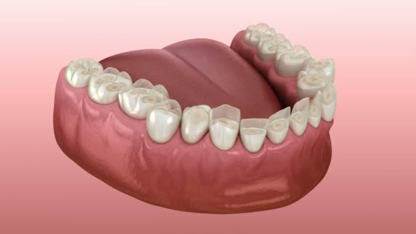 Desgaste dental (bruxismo) que resulta en la pérdida de tejido dental. Animación 3D de dientes médicamente precisa — Vídeo de stock
