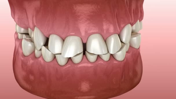 Zahnverschleiß (Bruxismus), der zum Verlust von Zahngewebe führt. medizinisch korrekte 3D-Animation der Zähne — Stockvideo