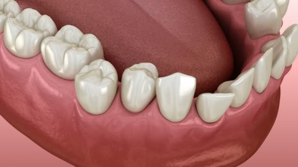 Posizione anormale dei denti, concetto ortodontico. Animazione 3D dei denti clinicamente accurata — Video Stock