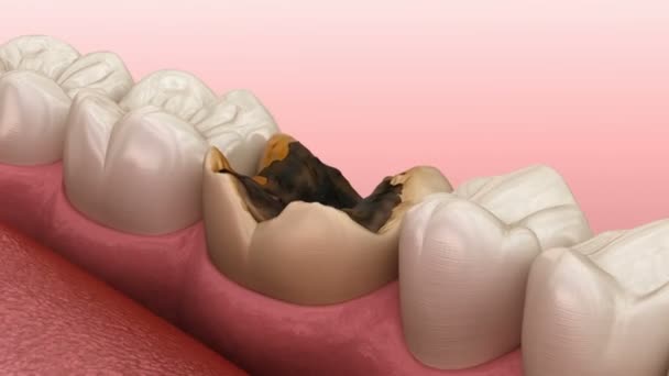 Μοριακή δόντια κατεστραμμένο από τερηδόνα. Ιατρικά ακριβές δόντι 3D κινούμενα σχέδια. — Αρχείο Βίντεο