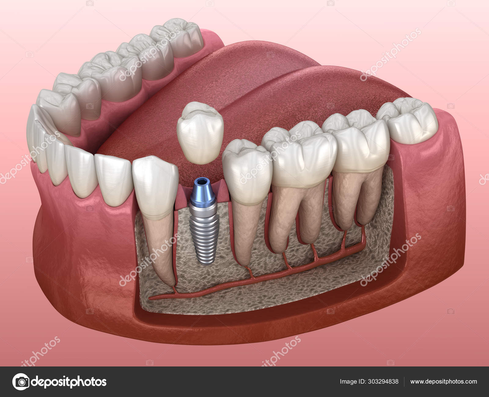 Dis Implant Tedavisi