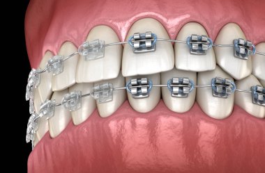 Teeth with metal and Clear braces in gums. Medically accurate dental 3D illustration clipart