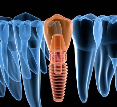 İmplant ile premolar diş kurtarma, x-Ray görünümü. İnsan dişleri ve protezkavramının tıbbi olarak doğru 3d illüstrasyon