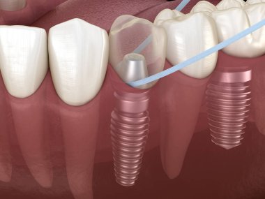 Diş ipi ile implant diş temizliği. Tıbbi olarak doğru 3d illüstrasyon