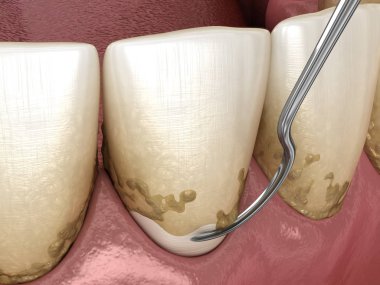 Ağız temizliği: Ölçekleme ve kök planlama (geleneksel periodontal terapi). İnsan diş tedavisinin tıbbi açıdan doğru üç boyutlu çizimi