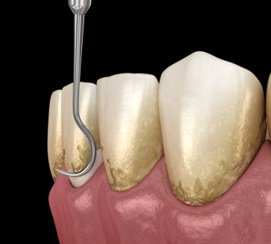 Ağız temizliği: Ölçekleme ve kök planlama (geleneksel periodontal terapi). İnsan diş tedavisinin tıbbi açıdan doğru üç boyutlu çizimi
