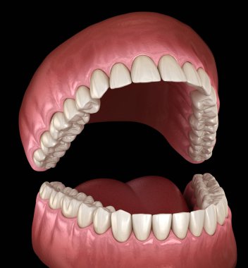 Diş anatomisi - Açık Protezler. Tıbbi olarak doğru diş 3d illüstrasyon