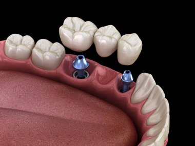 Diş köprüsü implantlarla destekleniyor. İnsan dişleri ve protez kavramının tıbben doğru üç boyutlu çizimi