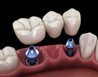 Diş köprüsü implantlarla destekleniyor. İnsan dişleri ve protez kavramının tıbben doğru üç boyutlu çizimi