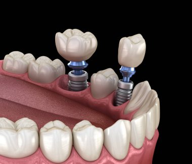 Premolar ve Molar diş taç implant abutments üzerinde kurulum. İnsan dişleri ve protezkavramının tıbbi olarak doğru 3d illüstrasyon