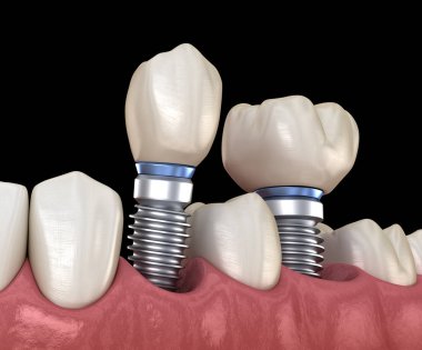 Premolar ve Molar diş taç implant abutments üzerinde kurulum. İnsan dişleri ve protezkavramının tıbbi olarak doğru 3d illüstrasyon