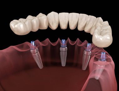 Alt çene protezi. Hepsi de implantlarla desteklenen 4 sistemde. İnsan dişleri ve protez kavramının tıbben doğru üç boyutlu çizimi
