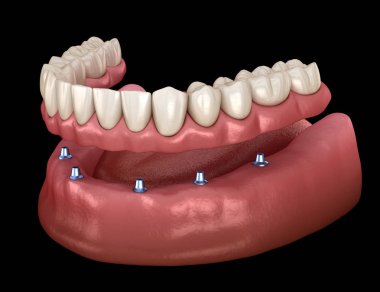 Mandibular çıkarılabilir protez Tüm 6 sistemi implantlar tarafından desteklenen. İnsan dişleri ve protezkavramının tıbbi olarak doğru 3d illüstrasyon