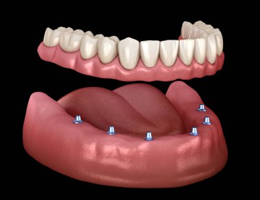 Mandibular çıkarılabilir protez Tüm 6 sistemi implantlar tarafından desteklenen. İnsan dişleri ve protezkavramının tıbbi olarak doğru 3d illüstrasyon