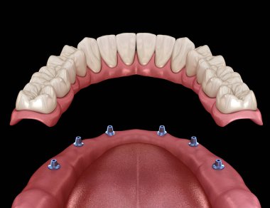Mandibular çıkarılabilir protez Tüm 6 sistemi implantlar tarafından desteklenen. İnsan dişleri ve protezkavramının tıbbi olarak doğru 3d illüstrasyon