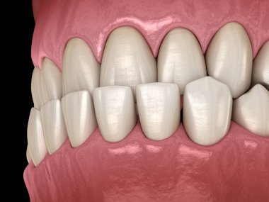 Underbite diş tıkanıklığı ( Dişlerin maloklüzyon ). Tıbbi olarak doğru diş 3d illüstrasyon