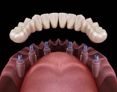 Çene protezi. Hepsi de implantlarla desteklenen 6 sistemde. İnsan dişleri ve protez kavramının tıbben doğru üç boyutlu çizimi