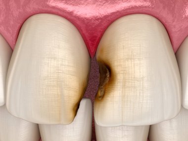 Merkezi kesici dişler çürüklerden zarar görmüş. Tıbbi olarak doğru diş 3d illüstrasyon.