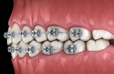 Diş etlerinde metal parantez ile Sağlıklı Dişler. Tıbbi olarak doğru diş 3d illüstrasyon