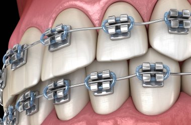 Diş etlerinde metal parantez ile Sağlıklı Dişler. Tıbbi olarak doğru diş 3d illüstrasyon