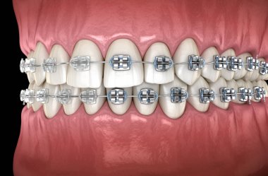 Diş etlerinde metal ve şeffaf diş telleri olan dişler. Tıbbi olarak doğru diş 3d illüstrasyon