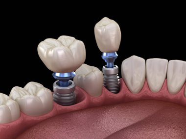 Premolar ve Molar diş taç implant üzerine kurulum - kavram. İnsan dişleri ve protezleri 3d illüstrasyon