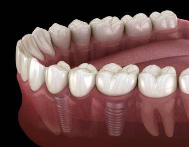 Diş köprüsü implantlarla destekleniyor. İnsan dişleri ve protez kavramının tıbben doğru üç boyutlu çizimi